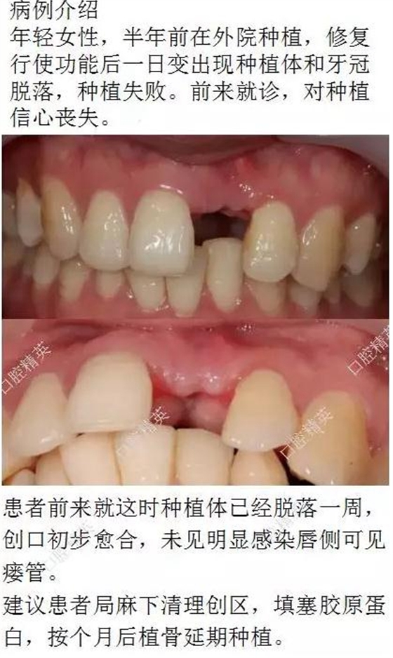 種植失敗的骨增量處理一例 種植失敗的骨增量處理一例