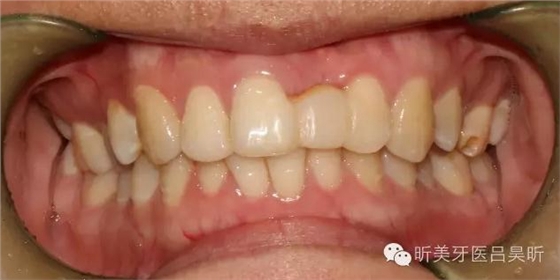 種植失敗的骨增量處理一例 種植失敗的骨增量處理一例