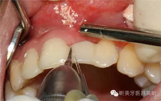 種植失敗的骨增量處理一例 種植失敗的骨增量處理一例