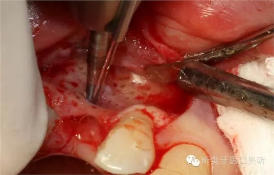 種植失敗的骨增量處理一例 種植失敗的骨增量處理一例