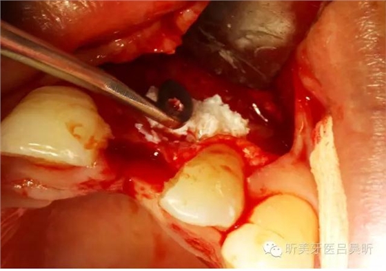 種植失敗的骨增量處理一例 種植失敗的骨增量處理一例