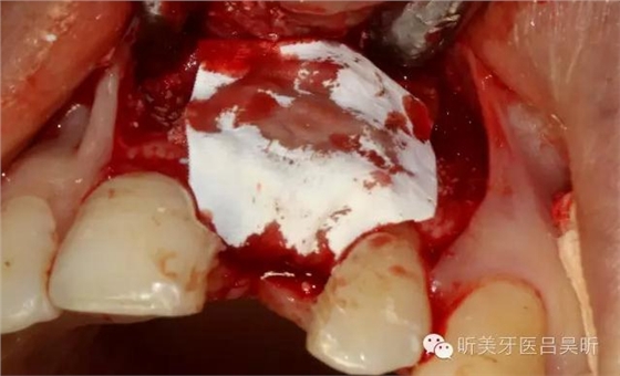 種植失敗的骨增量處理一例 種植失敗的骨增量處理一例