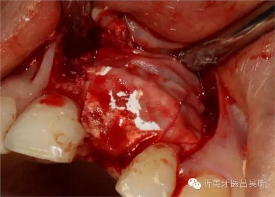 種植失敗的骨增量處理一例 種植失敗的骨增量處理一例