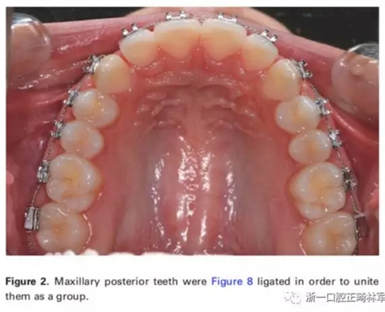 正畸文獻(xiàn)閱讀-兩種不同矯治力下上頜后牙段遠(yuǎn)移的生化與臨床比較 正畸文獻(xiàn)閱讀-兩種不同矯治力下上頜后牙段遠(yuǎn)移的生化與臨床比較