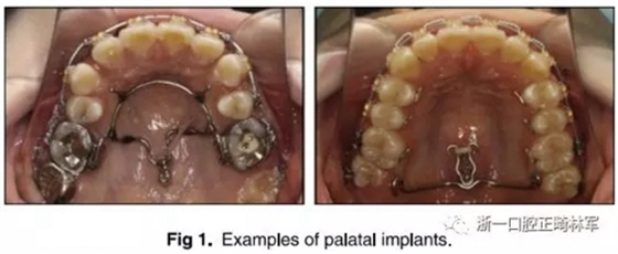 正畸文獻閱讀--上頜支抗初次植入失敗后二次植入穩(wěn)定性的研究 正畸文獻閱讀--上頜支抗初次植入失敗后二次植入穩(wěn)定性的研究