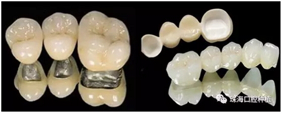 固定假牙(烤瓷牙)的致命缺點 固定假牙(烤瓷牙)的致命缺點