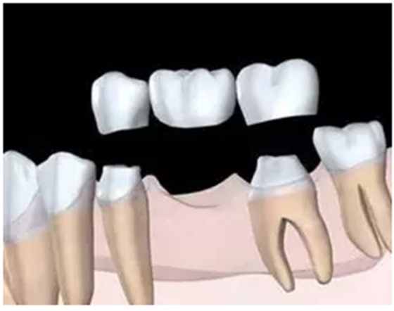 固定假牙(烤瓷牙)的致命缺點 固定假牙(烤瓷牙)的致命缺點