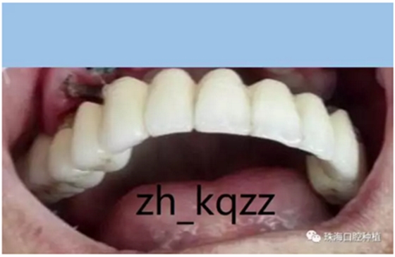 固定假牙(烤瓷牙)的致命缺點 固定假牙(烤瓷牙)的致命缺點