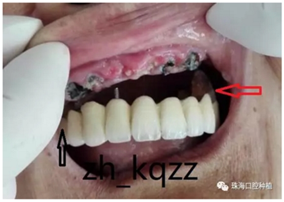 固定假牙(烤瓷牙)的致命缺點 固定假牙(烤瓷牙)的致命缺點