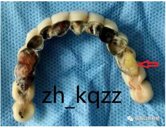 固定假牙(烤瓷牙)的致命缺點 固定假牙(烤瓷牙)的致命缺點