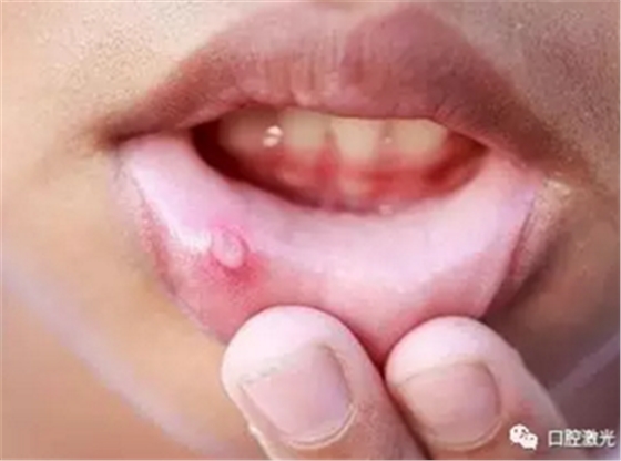 原創(chuàng) |利用半導(dǎo)體激光治療口腔潰瘍 原創(chuàng) |利用半導(dǎo)體激光治療口腔潰瘍