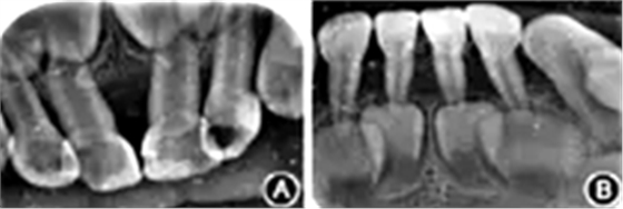 重型先天性中性粒細(xì)胞缺乏癥伴牙周損害 重型先天性中性粒細(xì)胞缺乏癥伴牙周損害
