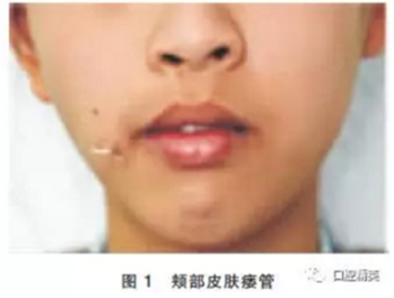 面頰部皮樣囊腫伴皮瘺1例報道 面頰部皮樣囊腫伴皮瘺1例報道