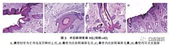 面頰部皮樣囊腫伴皮瘺1例報道 面頰部皮樣囊腫伴皮瘺1例報道