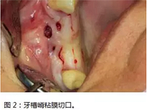 上頜竇瘺修補(bǔ)術(shù)——改良式旋轉(zhuǎn)帶蒂粘膜瓣修補(bǔ)術(shù)的應(yīng)用 上頜竇瘺修補(bǔ)術(shù)——改良式旋轉(zhuǎn)帶蒂粘膜瓣修補(bǔ)術(shù)的應(yīng)用