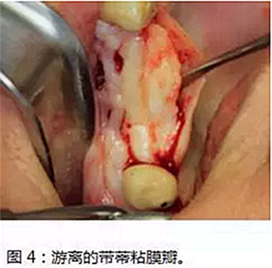 上頜竇瘺修補(bǔ)術(shù)——改良式旋轉(zhuǎn)帶蒂粘膜瓣修補(bǔ)術(shù)的應(yīng)用 上頜竇瘺修補(bǔ)術(shù)——改良式旋轉(zhuǎn)帶蒂粘膜瓣修補(bǔ)術(shù)的應(yīng)用