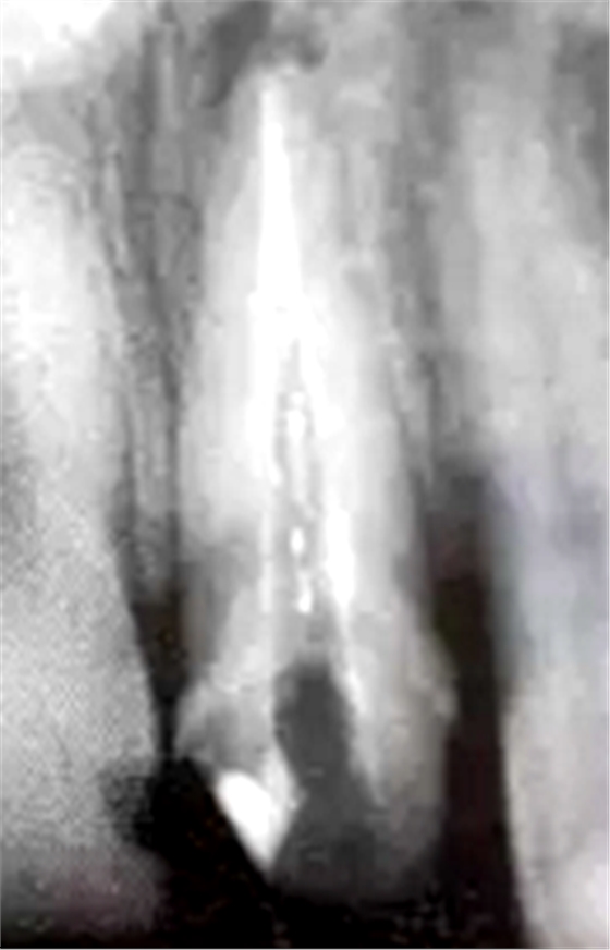 纖維樁修復(fù)之精細(xì)操作 纖維樁修復(fù)之精細(xì)操作