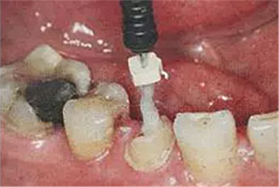 纖維樁修復(fù)之精細(xì)操作 纖維樁修復(fù)之精細(xì)操作