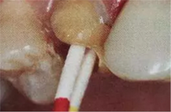 纖維樁修復(fù)之精細(xì)操作 纖維樁修復(fù)之精細(xì)操作