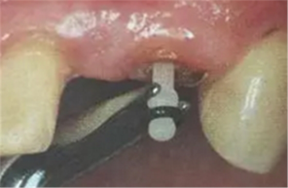 纖維樁修復(fù)之精細(xì)操作 纖維樁修復(fù)之精細(xì)操作