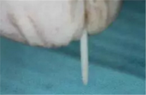 纖維樁修復(fù)之精細(xì)操作 纖維樁修復(fù)之精細(xì)操作