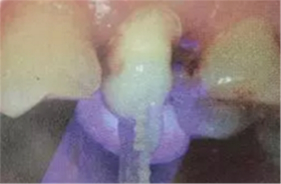 纖維樁修復(fù)之精細(xì)操作 纖維樁修復(fù)之精細(xì)操作