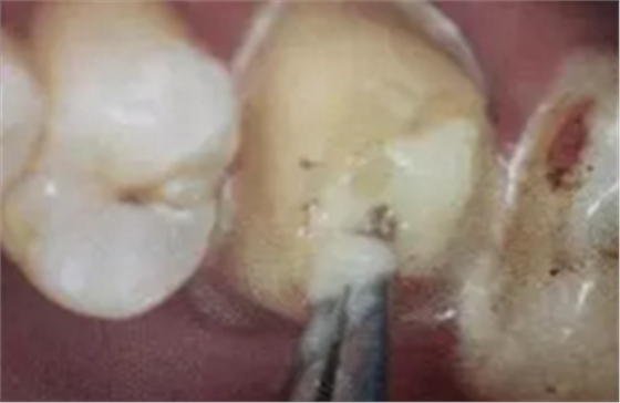 纖維樁修復(fù)之精細(xì)操作 纖維樁修復(fù)之精細(xì)操作