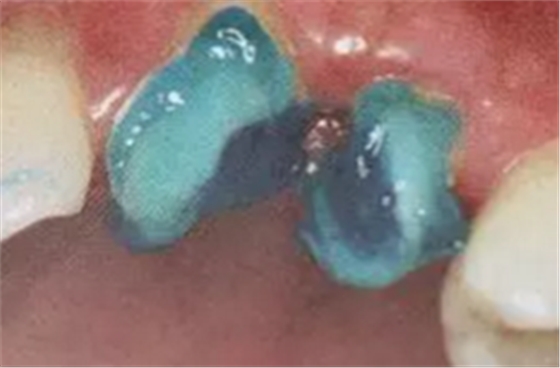 纖維樁修復(fù)之精細(xì)操作 纖維樁修復(fù)之精細(xì)操作