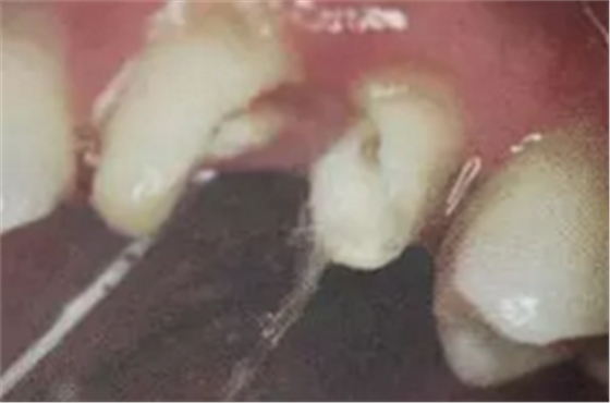 纖維樁修復(fù)之精細(xì)操作 纖維樁修復(fù)之精細(xì)操作