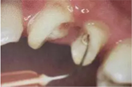 纖維樁修復(fù)之精細(xì)操作 纖維樁修復(fù)之精細(xì)操作