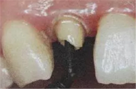 纖維樁修復(fù)之精細(xì)操作 纖維樁修復(fù)之精細(xì)操作