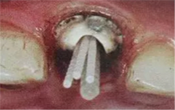 纖維樁修復(fù)之精細(xì)操作 纖維樁修復(fù)之精細(xì)操作