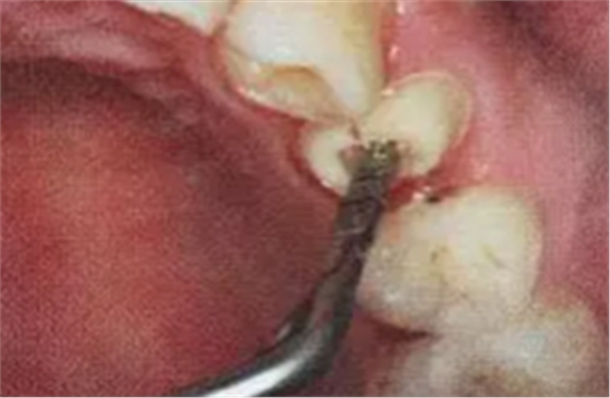 纖維樁修復(fù)之精細(xì)操作 纖維樁修復(fù)之精細(xì)操作