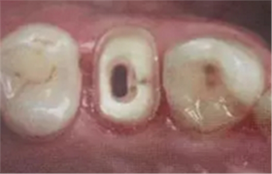 纖維樁修復(fù)之精細(xì)操作 纖維樁修復(fù)之精細(xì)操作