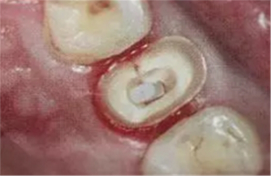 纖維樁修復(fù)之精細(xì)操作 纖維樁修復(fù)之精細(xì)操作