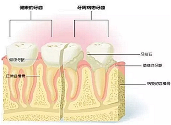 牙周病發(fā)展過程 牙周病發(fā)展過程