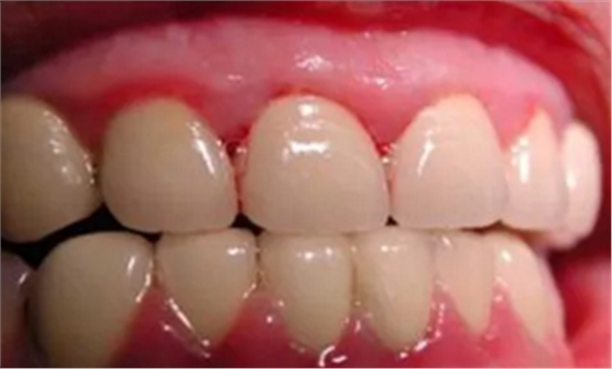 牙周病發(fā)展過程 牙周病發(fā)展過程