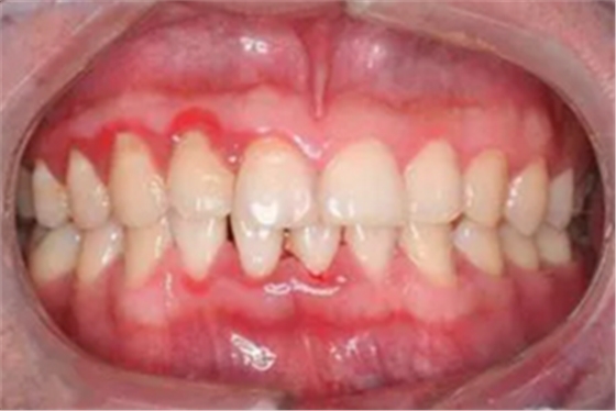 牙周病發(fā)展過程 牙周病發(fā)展過程