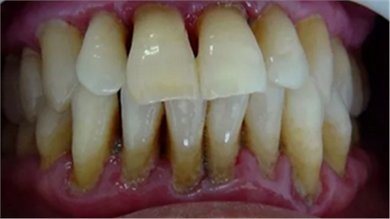 牙周病發(fā)展過程 牙周病發(fā)展過程