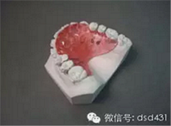 是什么導(dǎo)致了義齒返工？？？