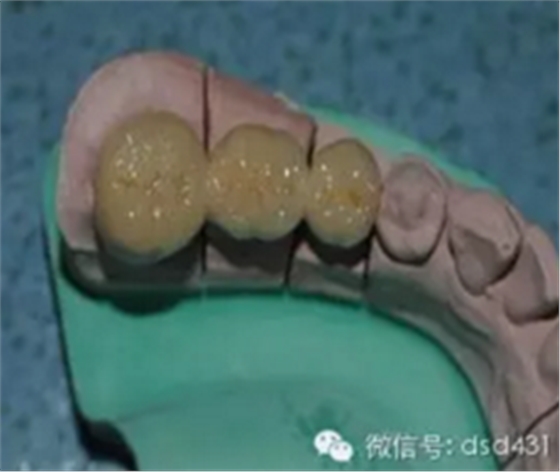 是什么導(dǎo)致了義齒返工？？？