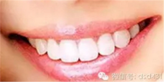 是什么導(dǎo)致了義齒返工？？？