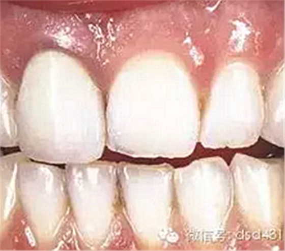 是什么導(dǎo)致了義齒返工？