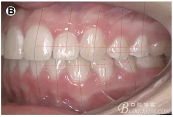 【原創(chuàng)博客】淺談間接粘托槽托槽的方法與技巧 【原創(chuàng)博客】淺談間接粘托槽托槽的方法與技巧