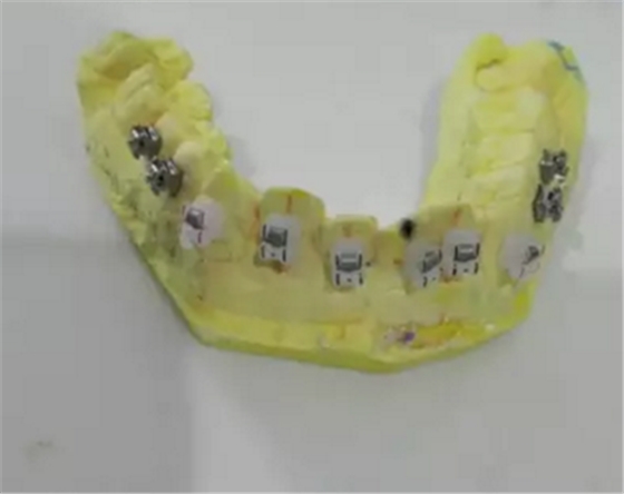 【原創(chuàng)博客】淺談間接粘托槽托槽的方法與技巧 【原創(chuàng)博客】淺談間接粘托槽托槽的方法與技巧