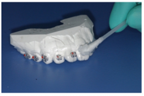 【原創(chuàng)博客】淺談間接粘托槽托槽的方法與技巧 【原創(chuàng)博客】淺談間接粘托槽托槽的方法與技巧