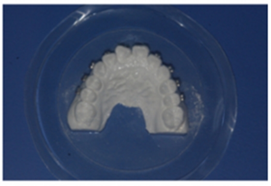 【原創(chuàng)博客】淺談間接粘托槽托槽的方法與技巧 【原創(chuàng)博客】淺談間接粘托槽托槽的方法與技巧