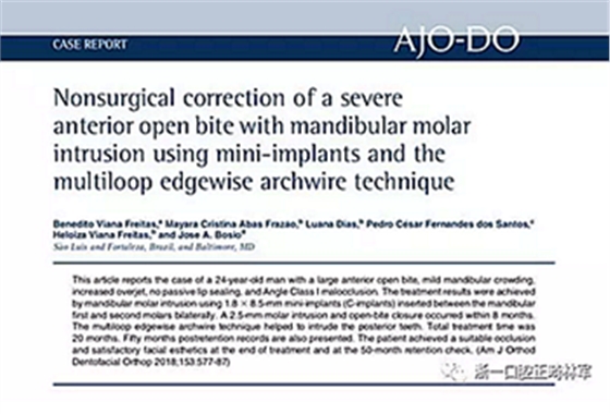 文獻優(yōu)秀正畸病例賞析-通過微種植釘及多曲方絲技術(shù)壓低下頜磨牙非手術(shù)矯治嚴(yán)重前牙開合患者1例 文獻優(yōu)秀正畸病例賞析-通過微種植釘及多曲方絲技術(shù)壓低下頜磨牙非手術(shù)矯治嚴(yán)重前牙開合患者1例