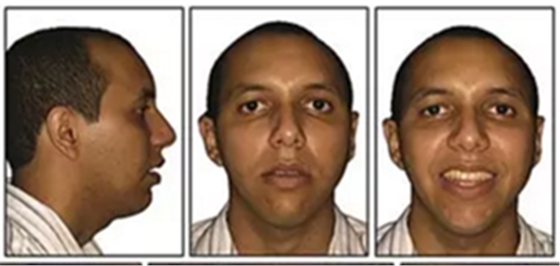 文獻優(yōu)秀正畸病例賞析-通過微種植釘及多曲方絲技術(shù)壓低下頜磨牙非手術(shù)矯治嚴(yán)重前牙開合患者1例 文獻優(yōu)秀正畸病例賞析-通過微種植釘及多曲方絲技術(shù)壓低下頜磨牙非手術(shù)矯治嚴(yán)重前牙開合患者1例