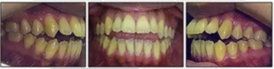 文獻優(yōu)秀正畸病例賞析-通過微種植釘及多曲方絲技術(shù)壓低下頜磨牙非手術(shù)矯治嚴(yán)重前牙開合患者1例 文獻優(yōu)秀正畸病例賞析-通過微種植釘及多曲方絲技術(shù)壓低下頜磨牙非手術(shù)矯治嚴(yán)重前牙開合患者1例